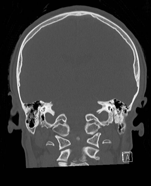 File:Base of skull fracture with bilateral Le Fort fractures (Radiopaedia 47094-51638 Coronal bone window 40).jpg