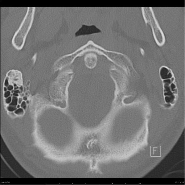 File:Bilateral cervical ribs (Radiopaedia 25868-26017 Axial bone window 5).jpg