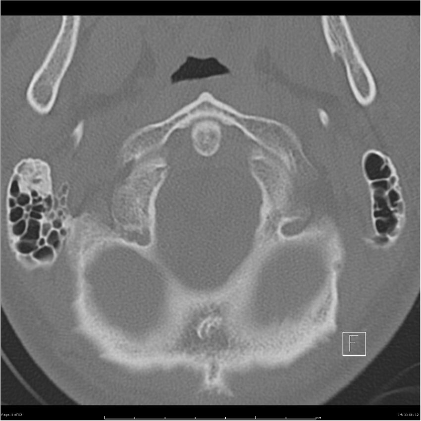 Bilateral cervical ribs (Radiopaedia 25868-26017 Axial bone window 5).jpg