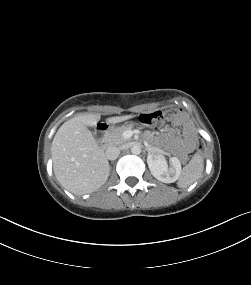 Bilateral kidney malrotation (Radiopaedia 72227-82749 A 11).jpg