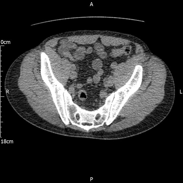 File:Bilateral medullary nephrocalcinosis with ureteric calculi (Radiopaedia 71269-81569 Axial non-contrast 106).jpg
