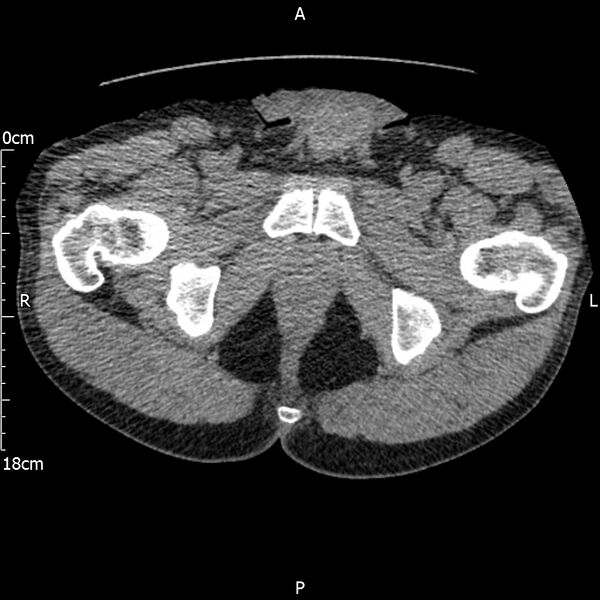 File:Bilateral medullary nephrocalcinosis with ureteric calculi (Radiopaedia 71269-81569 Axial non-contrast 137).jpg
