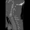 Bilateral perched facets with cord injury (Radiopaedia 45587-49713 Sagittal bone window 30).jpg