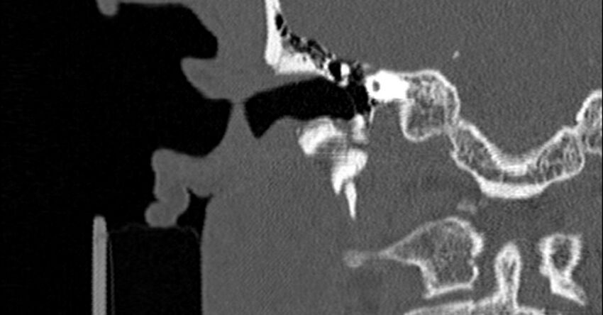 Bilateral temporal bone fractures (Radiopaedia 29482-29970 Coronal non-contrast 91).jpg