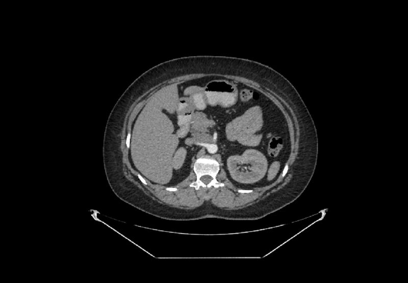 File:Bilateral urolithiasis with incidentally detected splenic artery aneurysm and left inferior vena cava (Radiopaedia 44467-48127 A 28).jpg