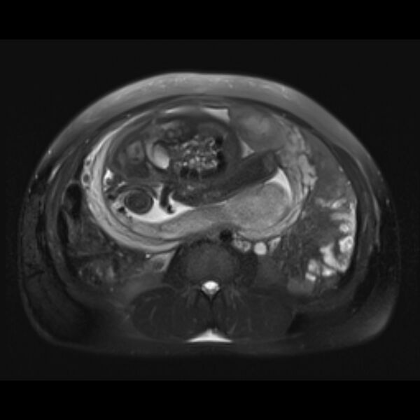 File:Bilobed placenta accreta (Radiopaedia 69648-79591 Axial T2 fat sat 17).jpg