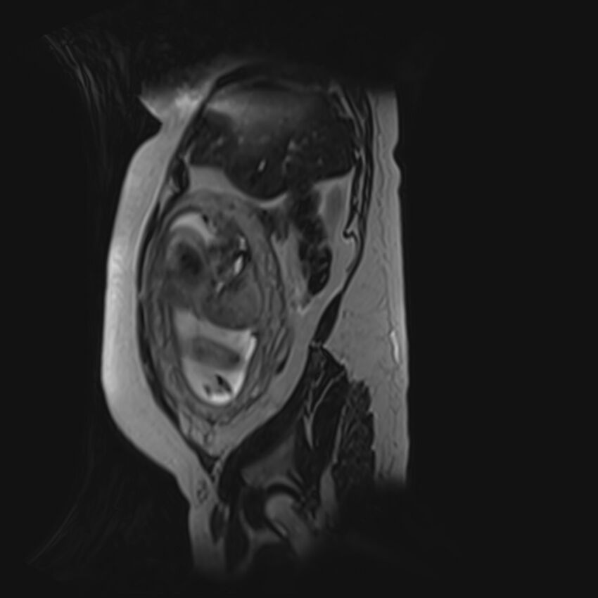 Bilobed placenta accreta (Radiopaedia 69648-79591 G 50).jpg
