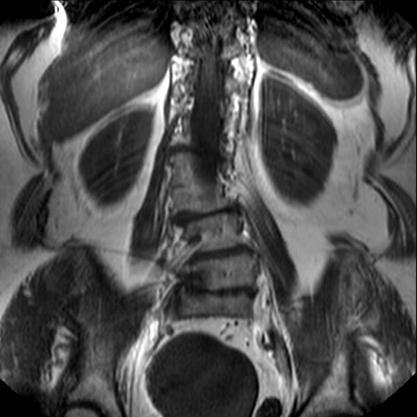 File:Block vertebrae (Radiopaedia 57940-64916 Coronal T1 9).jpg