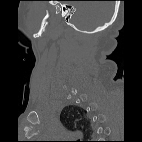 File:Blunt cerebrovascular injury (Radiopaedia 53682-59743 Sagittal bone window 20).png