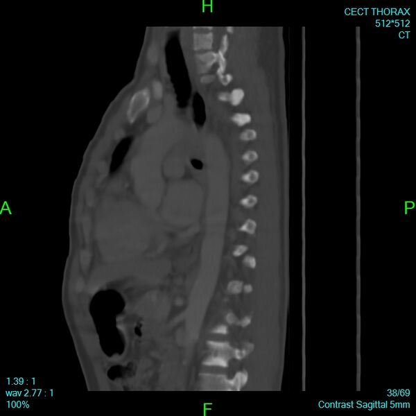 File:Bone metastases from lung carcinoma (Radiopaedia 54703-60937 Sagittal bone window 38).jpg