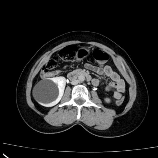 File:Bosniak renal cyst - type I (Radiopaedia 27479-27675 D 25).jpg