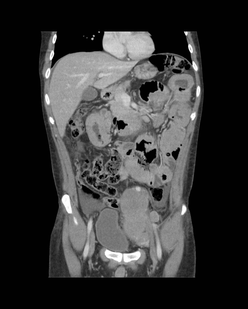 Bowel lymphoma complicated by bleeding after therapy (Radiopaedia 55601-62107 B 27).jpg