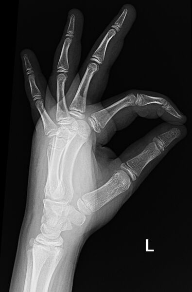 File:Boxer fracture (Radiopaedia 9727-10337 Oblique 3).jpg