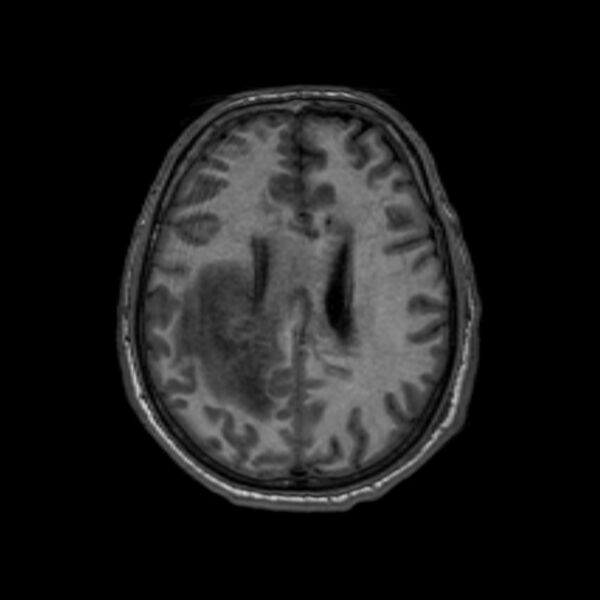 File:Brain abscess complicated by intraventricular rupture and ventriculitis (Radiopaedia 82434-96577 Axial T1 46).jpg