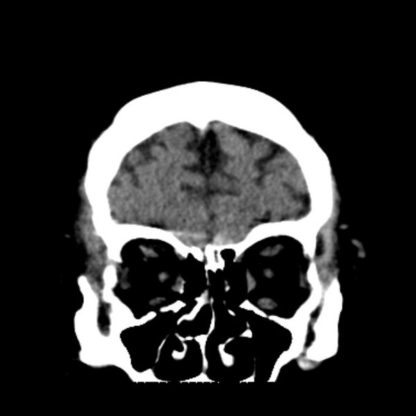 File:Brain cortical laminar necrosis (Radiopaedia 25822-25971 C 11).jpg