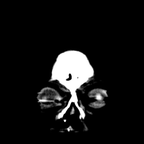 File:Brain cortical laminar necrosis (Radiopaedia 25822-25971 C 3).jpg