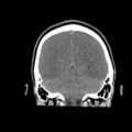 Brain death (Radiopaedia 78597-91360 Coronal non-contrast 55).jpg