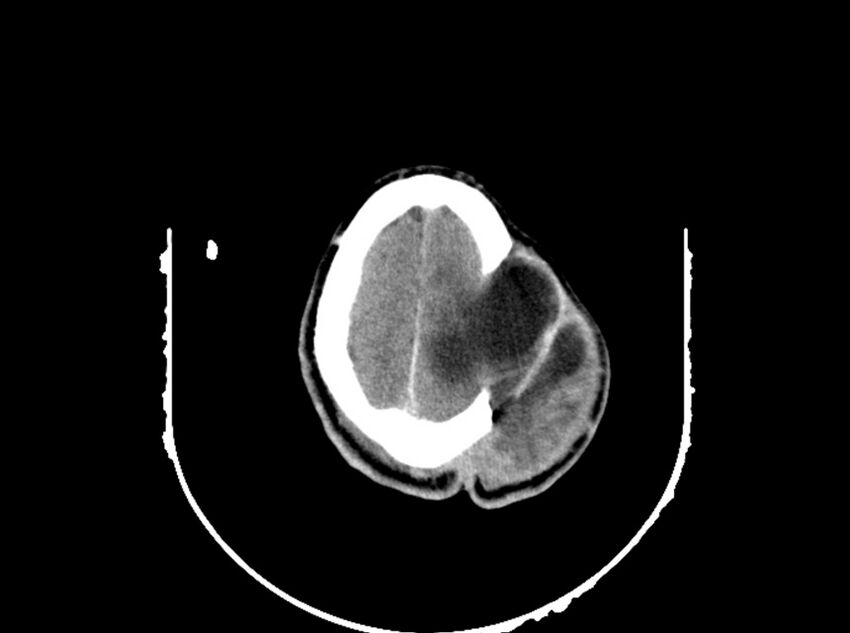 Brain injury by firearm projectile (Radiopaedia 82068-96088 A 180).jpg