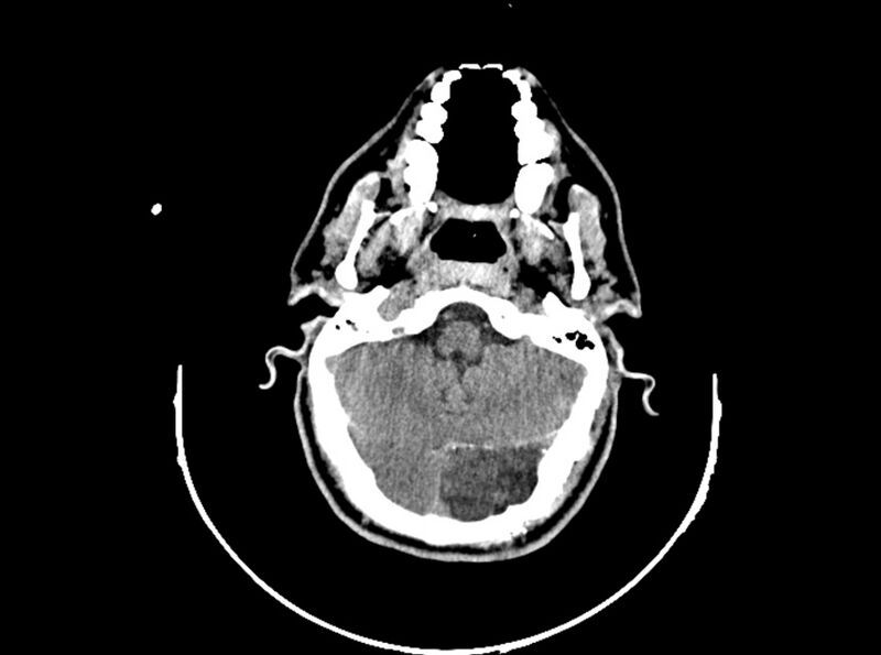File:Brain injury by firearm projectile (Radiopaedia 82068-96088 A 75).jpg