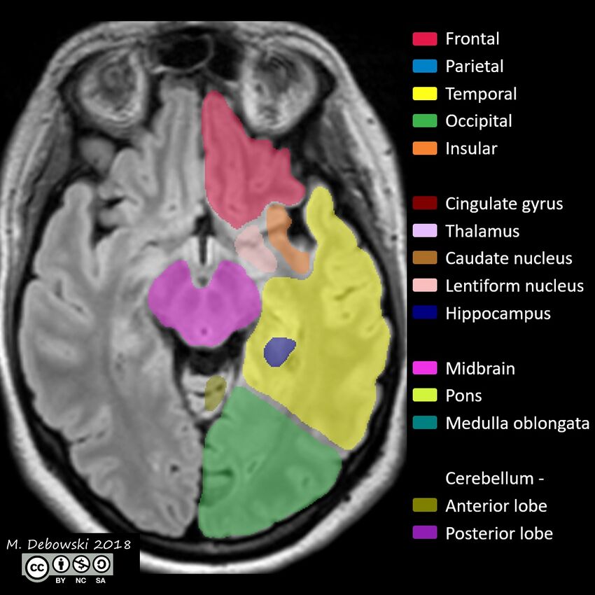 Brain lobes - annotated MRI (Radiopaedia 61691-69700 Axial 45).JPG