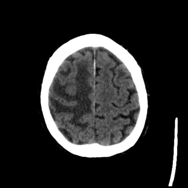 File:Brain metastases from lung cancer (Radiopaedia 27849-28092 Axial non-contrast 38).jpg