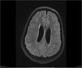 Brainstem glioma (Radiopaedia 21819-21775 Axial FLAIR 27).jpg