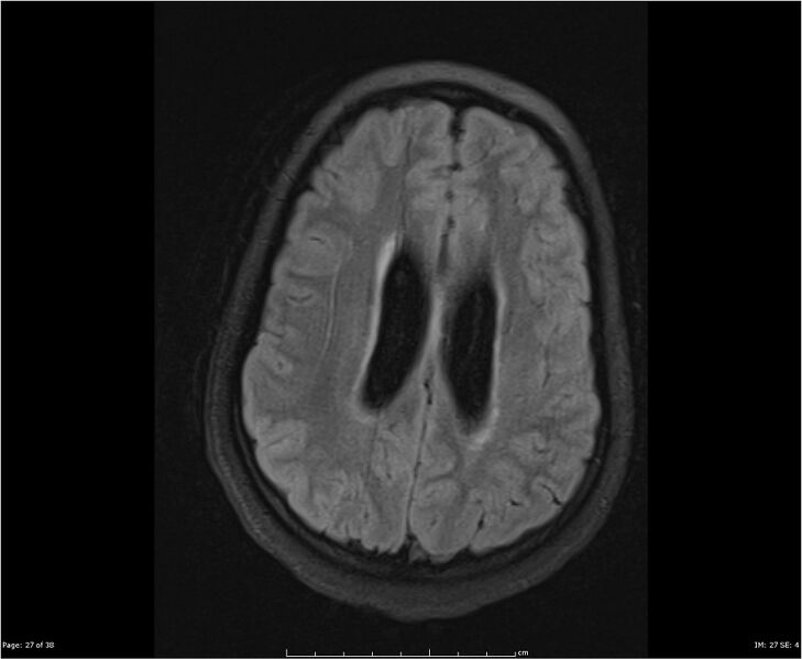 File:Brainstem glioma (Radiopaedia 21819-21775 Axial FLAIR 27).jpg