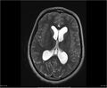 Brainstem glioma (Radiopaedia 21819-21775 Axial T2 22).jpg