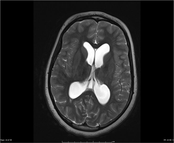 File:Brainstem glioma (Radiopaedia 21819-21775 Axial T2 22).jpg