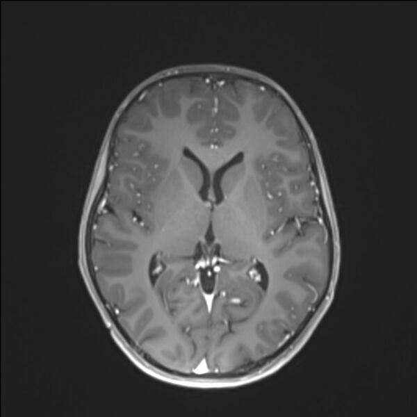 File:Brainstem glioma (Radiopaedia 70548-80674 Axial T1 C+ 85).jpg