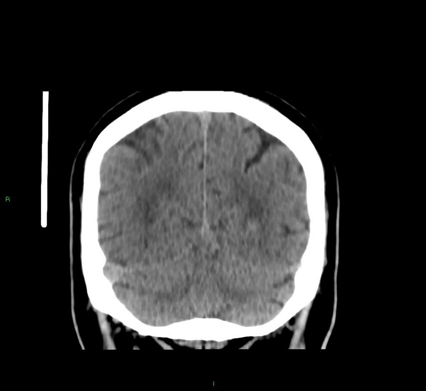 Brainstem hemorrhage (Radiopaedia 58794-66028 Coronal non-contrast 18).jpg