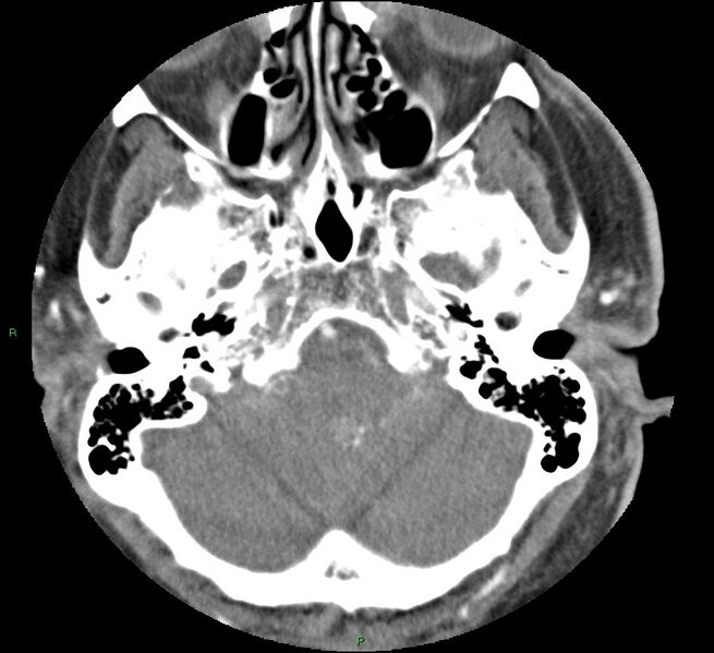 File:Brainstem hemorrhage (Radiopaedia 58794-66028 D 39).jpg