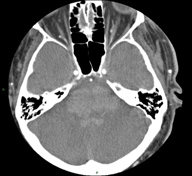 File:Brainstem hemorrhage (Radiopaedia 58794-66028 D 57).jpg