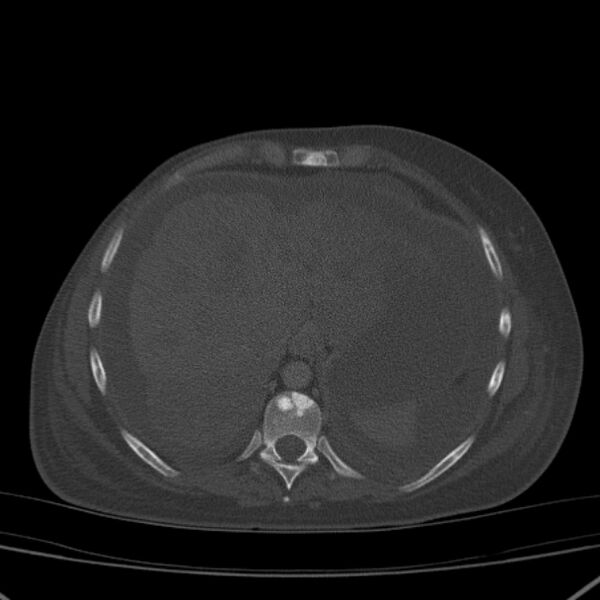 File:Breast cancer metastases - hepatic and skeletal (Radiopaedia 34201-35461 Axial bone window 32).jpg
