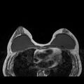 Breast implants - MRI (Radiopaedia 26864-27035 Axial T1 26).jpg