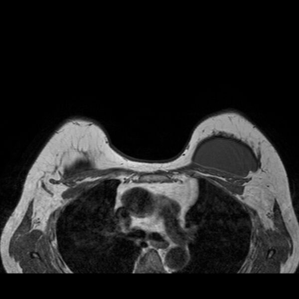 File:Breast implants - MRI (Radiopaedia 26864-27035 Axial T1 39).jpg