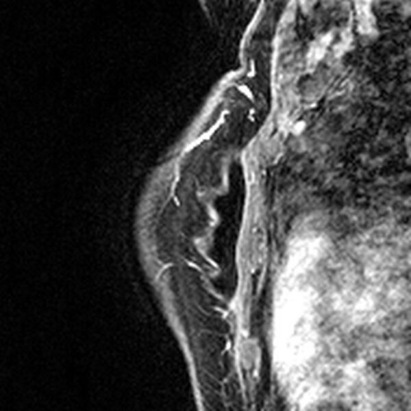 File:Breast implants - MRI (Radiopaedia 26864-27035 Sagittal T2 47).jpg