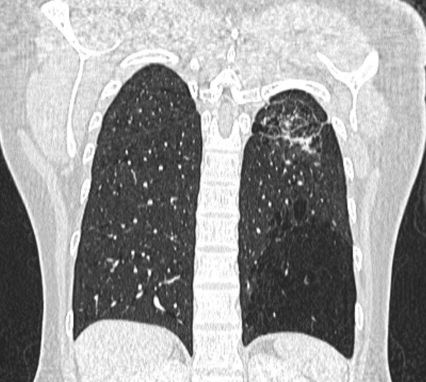 Bronchial atresia (Radiopaedia 50007-55297 Coronal lung window 92).jpg
