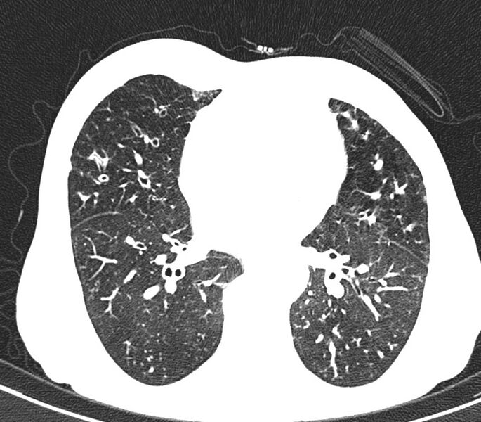 File:Bronchiolitis (Radiopaedia 24616-24887 Axial lung window 34).jpg