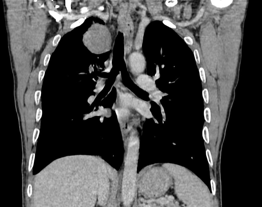 Bronchogenic carcinoma with superior vena cava syndrome (Radiopaedia 36497-38054 Coronal C+ delayed 58).jpg