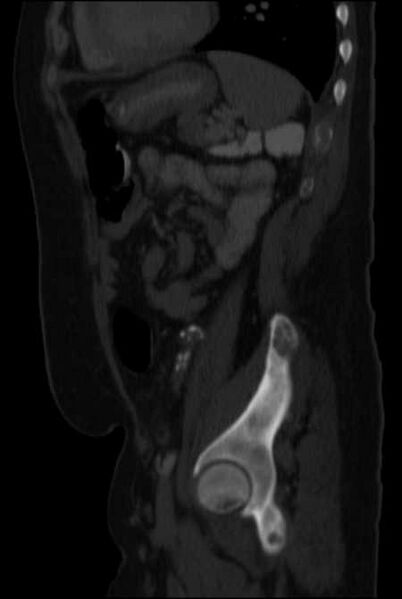 File:Brown tumors compressing the spinal cord (Radiopaedia 68442-77988 H 40).jpg