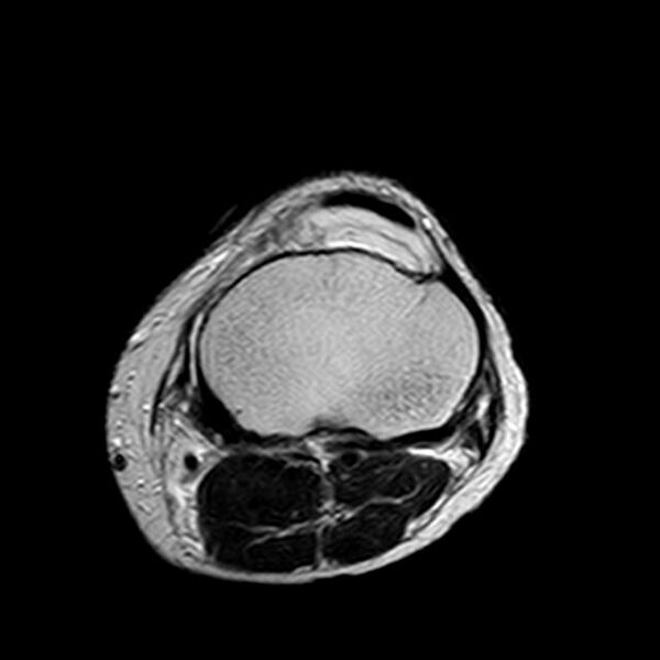 File:Bucket handle tear - medial meniscus (Radiopaedia 29250-29664 Axial T2 4).jpg
