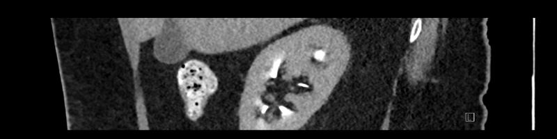 File:Buried bumper syndrome - gastrostomy tube (Radiopaedia 63843-72575 Sagittal Inject 92).jpg