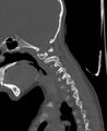 Butterfly vertebra (Radiopaedia 77903-90209 Sagittal bone window 20).jpg