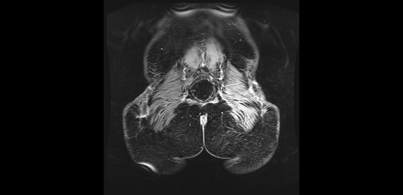 File:Buttock filler complications (Radiopaedia 63497-72115 Coronal T1 C+ 51).jpg