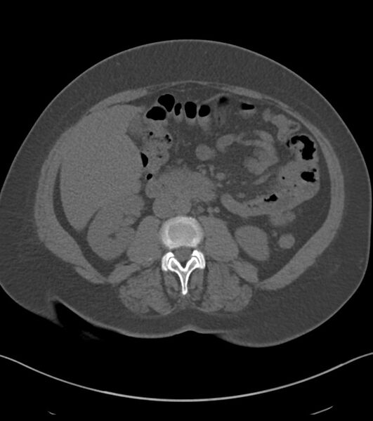 File:Calcified hepatic hydatid cyst (Radiopaedia 81127-94738 Axial non-contrast 48).jpg