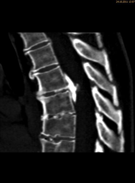 File:Calcified thoracic disc herniation (Radiopaedia 51984-57828 A 1).jpg