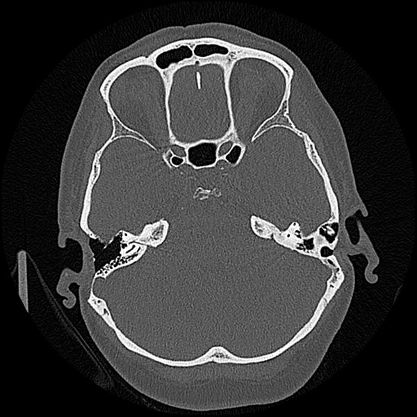 File:Canal up mastoidectomy (Radiopaedia 78108-90638 Axial bone window 98).jpg