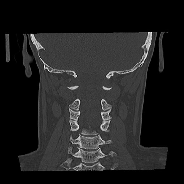 File:Canal up mastoidectomy (Radiopaedia 78108-90638 Coronal bone window 46).jpg