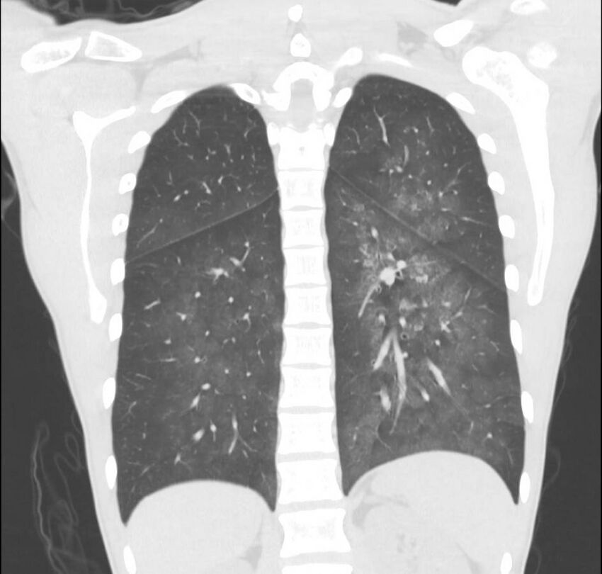 Cannabis-induced diffuse alveolar hemorrhage (Radiopaedia 89834-106946 Coronal lung window 26).jpg